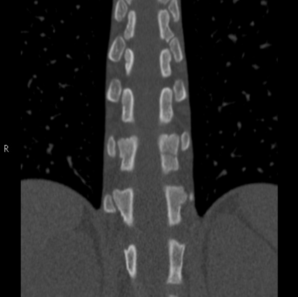 File:Chance fracture (Radiopaedia 36521-38081 Coronal bone window 33).jpg