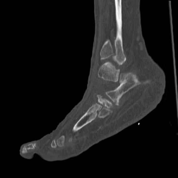 Charcot joint (Radiopaedia 36629-38194 Sagittal bone window 34).jpg
