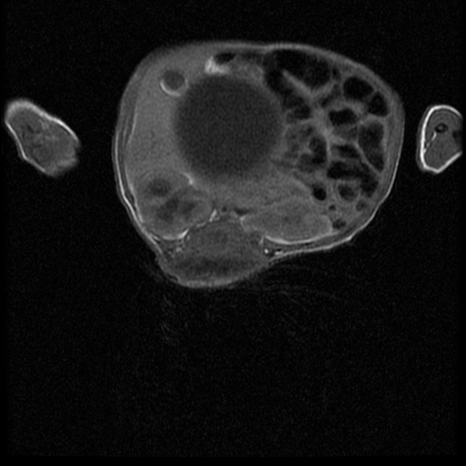File:Chiari II malformation with spinal meningomyelocele (Radiopaedia 23550-23652 Axial T1 11).jpg