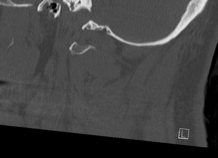 Chiari I malformation with a symptomatic syrinx of the posterolateral medulla oblongata (Radiopaedia 42573-45707 A 46).jpg
