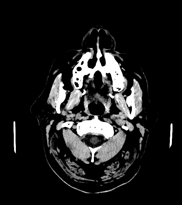 Cholangiocarcinoma with cerebral metastases (Radiopaedia 83519-98628 Axial non-contrast 3).jpg