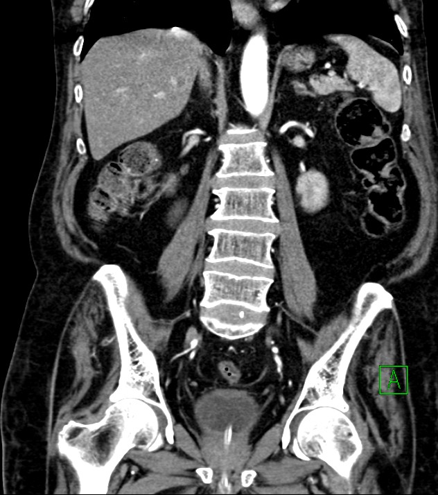 Cholangiocarcinoma with cerebral metastases (Radiopaedia 83519-98629 E 54).jpg