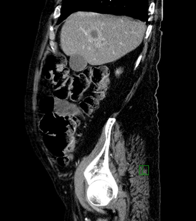 Cholangiocarcinoma with cerebral metastases (Radiopaedia 83519-98629 F 93).jpg