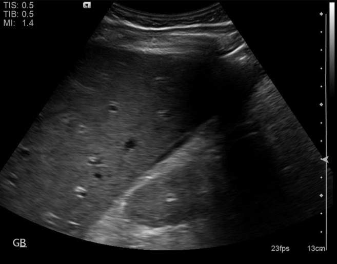 File:Cholecystitis - perforated gallbladder (Radiopaedia 57038-63913 A 13).jpg