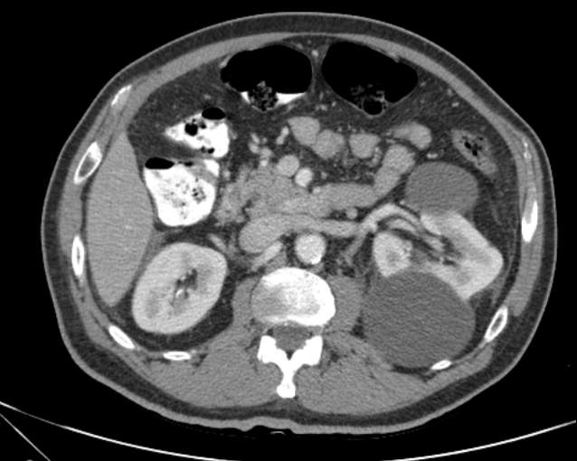 File:Cholecystitis - perforated gallbladder (Radiopaedia 57038-63916 A 36).jpg
