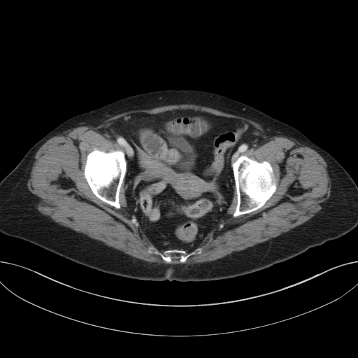 Cholecystoduodenal fistula due to calculous cholecystitis with gallstone migration (Radiopaedia 86875-103077 D 72).jpg