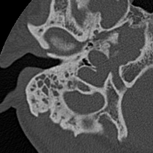 File:Cholesteatoma (Radiopaedia 15846-15494 bone window 24).jpg