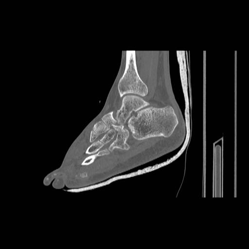 File:Chopart fracture (Radiopaedia 12386-12650 Sagittal bone window 15).jpg