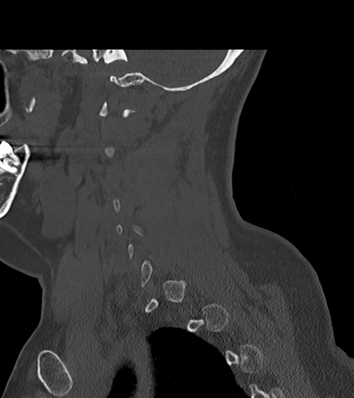 File:Chordoma (C4 vertebra) (Radiopaedia 47561-52188 Sagittal bone window 21).png