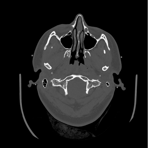 Choroid plexus papilloma extending into the cerebellopontine angle cistern (Radiopaedia 85941-101833 Axial bone window 18).png