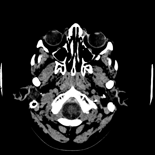 File:Choroid plexus xanthogranulomas (Radiopaedia 51621-57408 Axial non-contrast 5).jpg