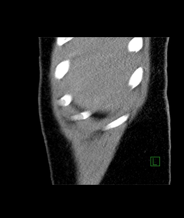 Chromophobe renal cell carcinoma (Radiopaedia 84255-99542 E 57).jpg