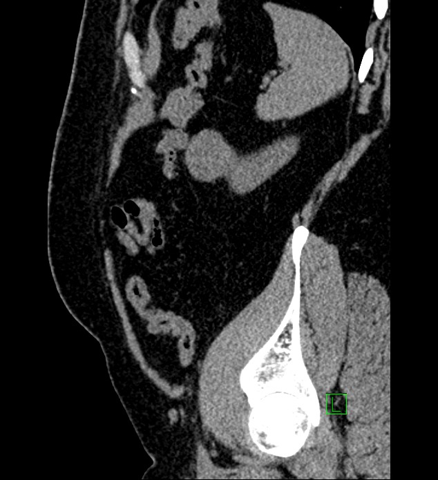 Chromophobe renal cell carcinoma (Radiopaedia 84286-99573 C 30).jpg