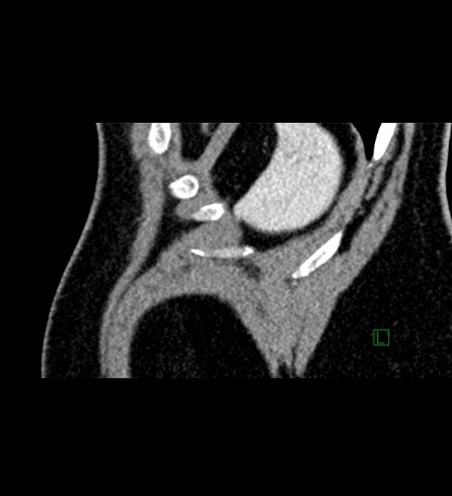 Chromophobe renal cell carcinoma (Radiopaedia 84286-99573 F 5).jpg