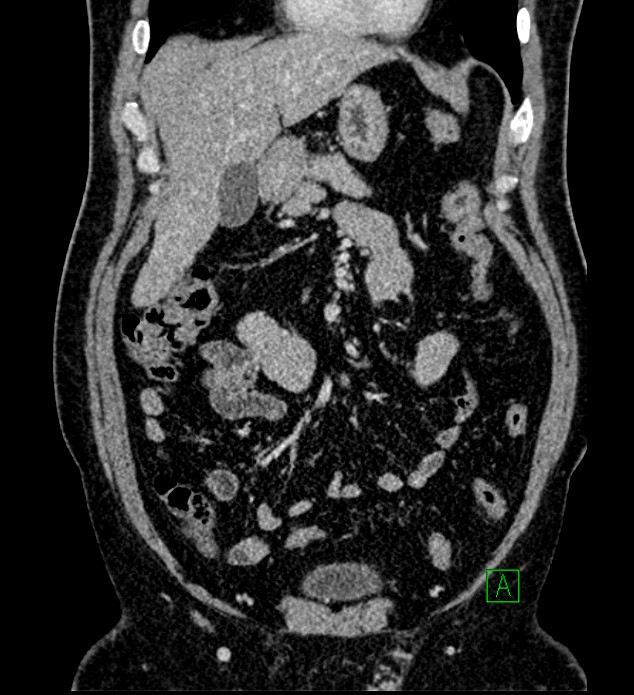 Chromophobe renal cell carcinoma (Radiopaedia 84286-99573 H 57).jpg