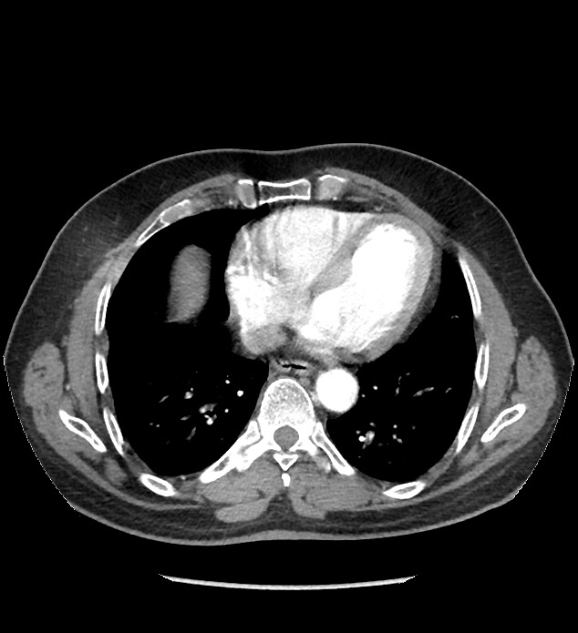 Chromophobe renal cell carcinoma (Radiopaedia 86879-103083 B 4).jpg