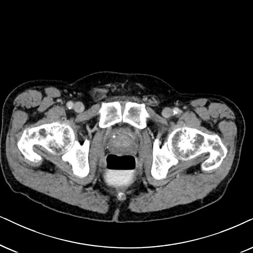 Chronic appendicitis complicated by appendicular abscess, pylephlebitis and liver abscess (Radiopaedia 54483-60700 B 145).jpg