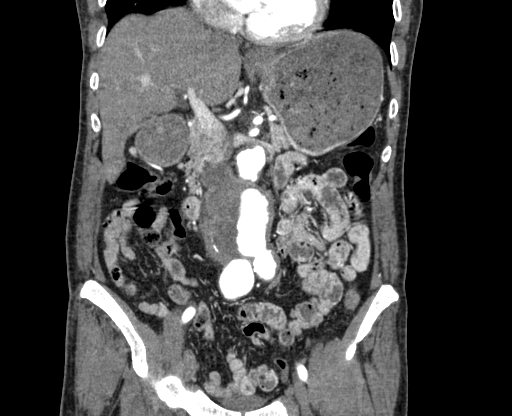 Chronic contained rupture of abdominal aortic aneurysm with extensive erosion of the vertebral bodies (Radiopaedia 55450-61901 D 26).jpg