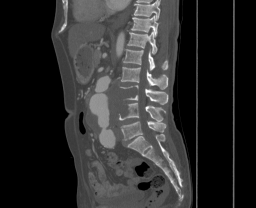 File:Chronic contained rupture of abdominal aortic aneurysm with extensive erosion of the vertebral bodies (Radiopaedia 55450-61901 Sagittal bone window 19).jpg