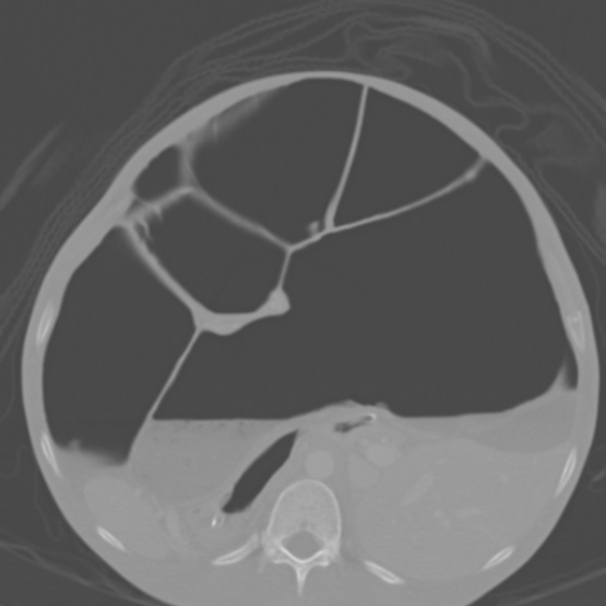 Chronic large bowel pseudo-obstruction (Radiopaedia 43181-46492 Axial bone window 69).jpg