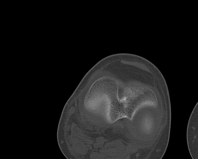 File:Chronic ostemyelitis of the femur with long sinus tract (Radiopaedia 74947-85982 Axial bone window 231).jpg