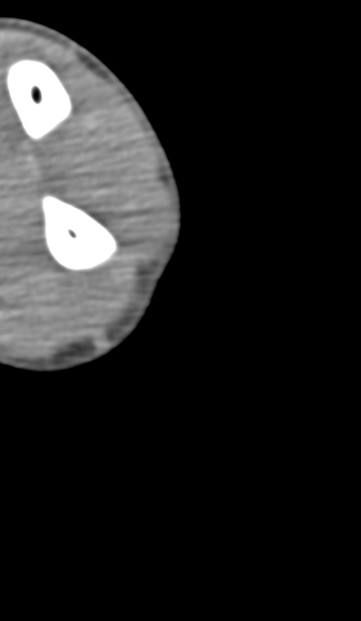 Chronic osteomyelitis of the distal humerus (Radiopaedia 78351-90971 Axial non-contrast 140).jpg