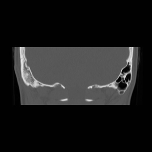 File:Chronic otomastoiditis (Radiopaedia 27138-27309 Coronal bone window 24).jpg
