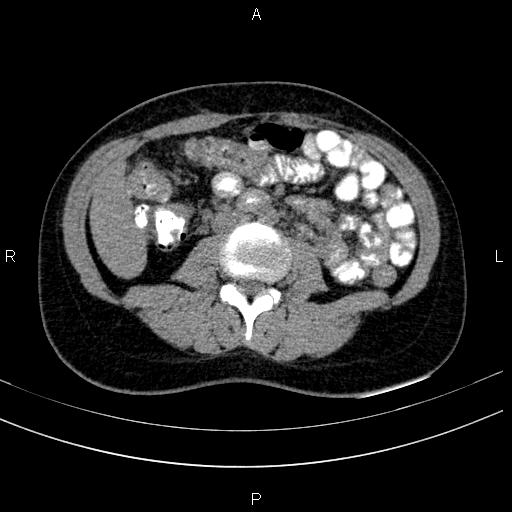 Chronic pancreatitis (Radiopaedia 64576-73450 Axial non-contrast 86).jpg