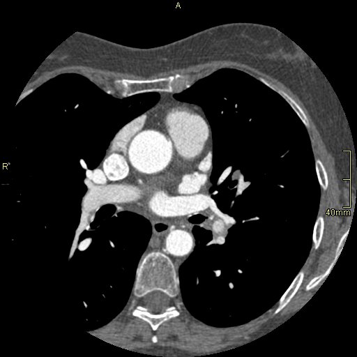 Chronic pulmonary embolism (Radiopaedia 73073-85094 Axial C+ CTPA 72).jpg