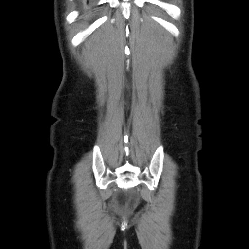 Chronic ureteropelvic junction obstruction (Radiopaedia 78365-90996 B 90).jpg