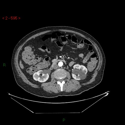File:Circumaortic left renal vein and doubled left renal arteries (Radiopaedia 52268-58158 A 131).jpg