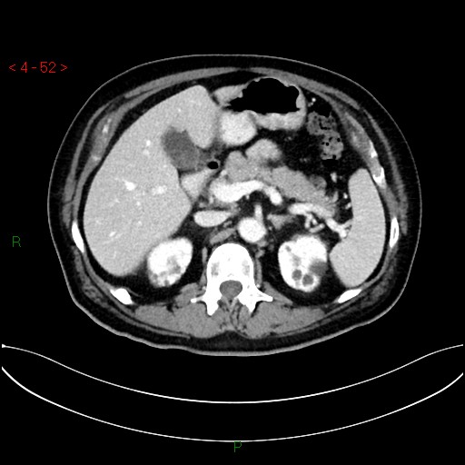 File:Circumaortic left renal vein and doubled left renal arteries (Radiopaedia 52268-58158 B 12).jpg