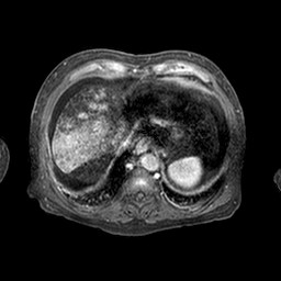 Cirrhosis and hepatocellular carcinoma in the setting of hemochromatosis (Radiopaedia 75394-86594 Axial T1 C+ fat sat 323).jpg
