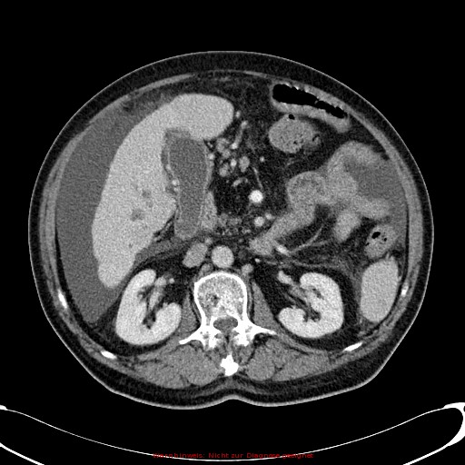 Cirrhosis and hepatocellular carcinoma in the setting of hemochromatosis (Radiopaedia 75394-86595 B 39).jpg