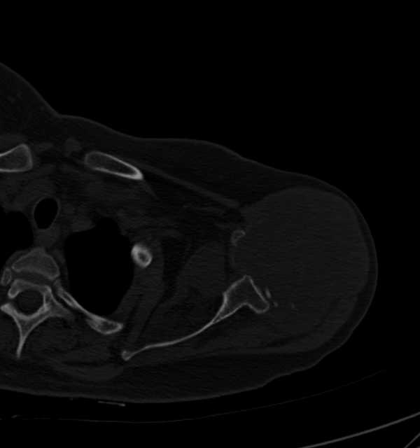 Clear cell chondrosarcoma - humerus (Radiopaedia 63104-71612 Axial bone window 32).jpg