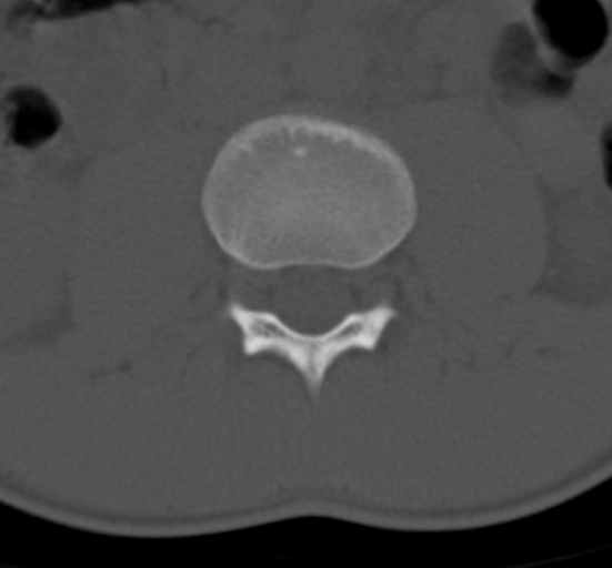 Clear cell meningoma - lumbar spine (Radiopaedia 60116-67691 Axial bone window 29).png