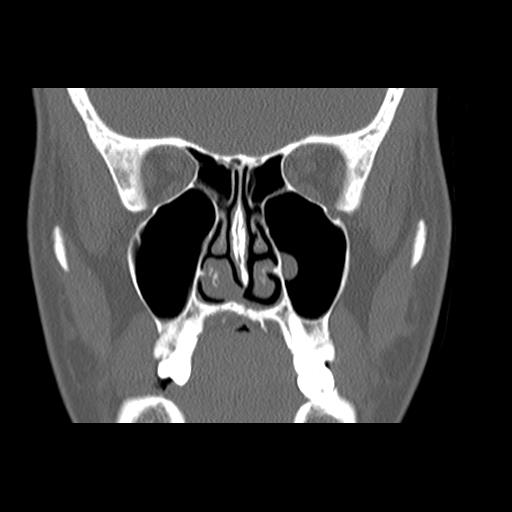 File:Cleft hard palate and alveolus (Radiopaedia 63180-71710 Coronal bone window 22).jpg