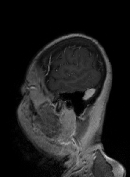 Clival meningioma (Radiopaedia 53278-59248 Sagittal T1 C+ 149).jpg