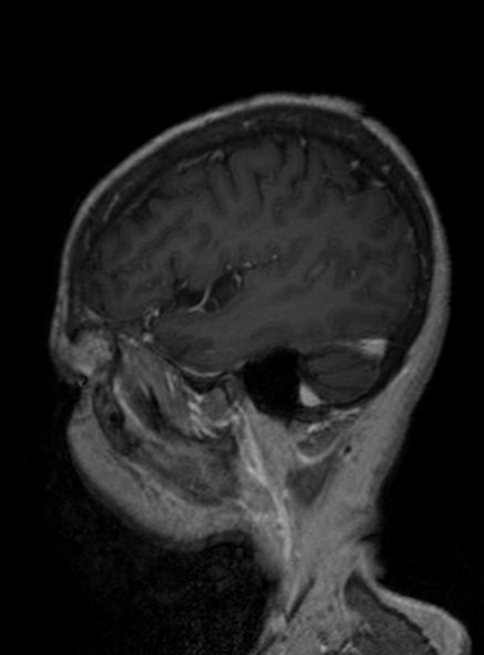 Clival meningioma (Radiopaedia 53278-59248 Sagittal T1 C+ 340).jpg
