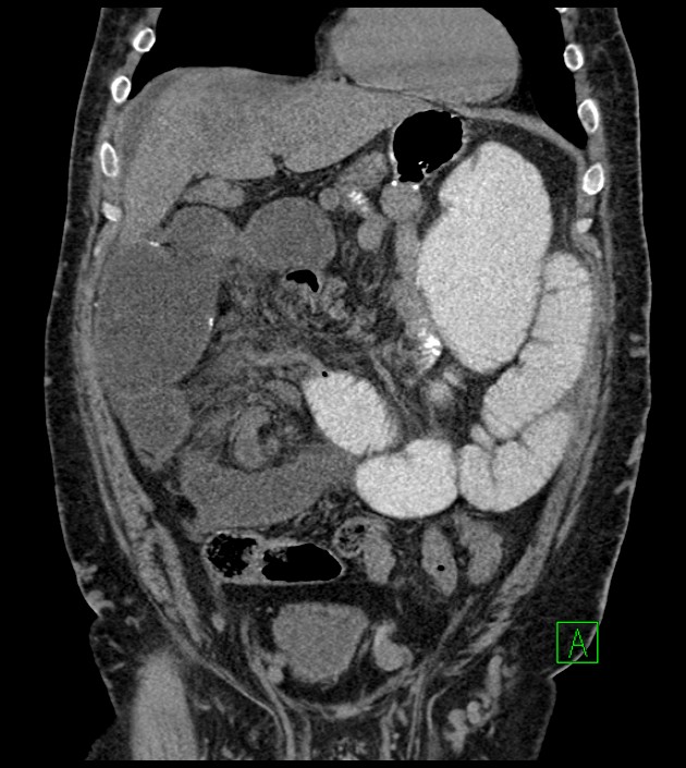 Closed-loop small bowel obstruction-internal hernia (Radiopaedia 78439-91096 Coronal non-contrast 37).jpg