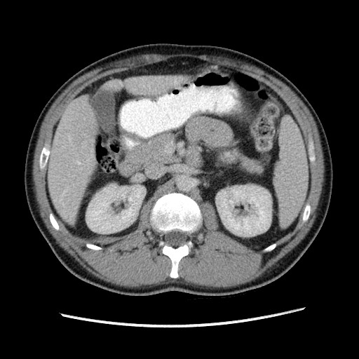 File:Closed-loop small bowel obstruction (Radiopaedia 73713-84509 A 61).jpg