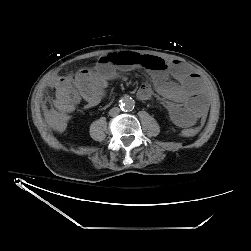 Closed loop obstruction due to adhesive band, resulting in small bowel ischemia and resection (Radiopaedia 83835-99023 Axial non-contrast 87).jpg