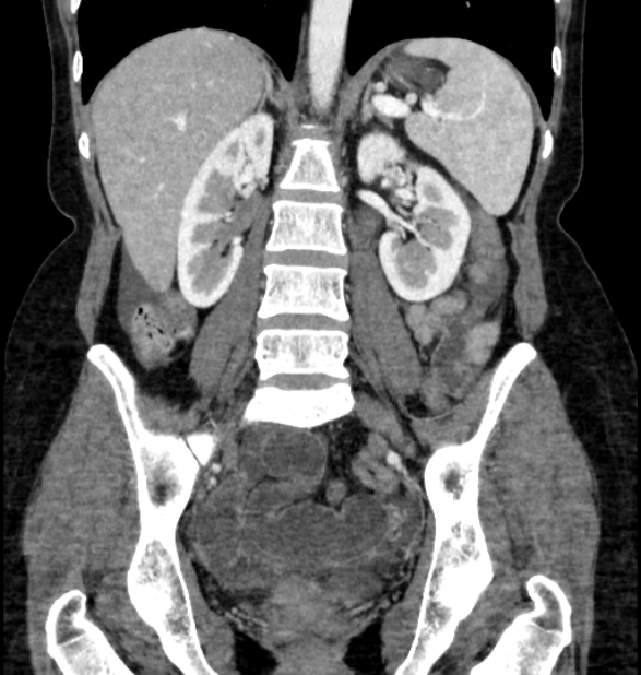 Closed loop small bowel obstruction (Radiopaedia 71211-81508 B 78).jpg