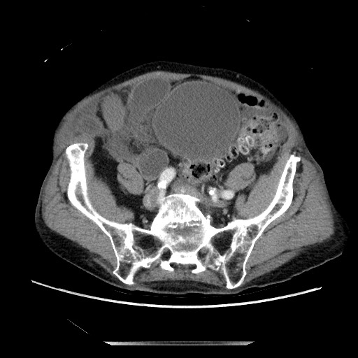 Closed loop small bowel obstruction - adhesive disease and hemorrhagic ischemia (Radiopaedia 86831-102990 A 136).jpg