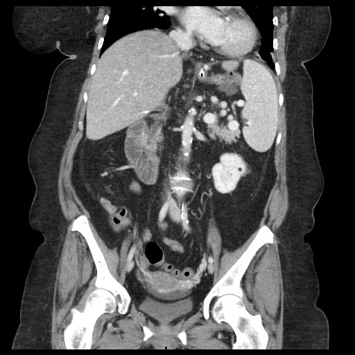 Closed loop small bowel obstruction - internal hernia (Radiopaedia 65402-74450 B 59).jpg