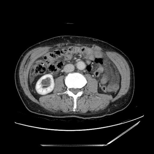 Closed loop small bowel obstruction - omental adhesion causing "internal hernia" (Radiopaedia 85129-100682 A 84).jpg