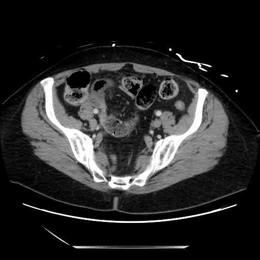 File:Closed loop small bowel obstruction due to adhesive bands - early and late images (Radiopaedia 83830-99014 A 118).jpg