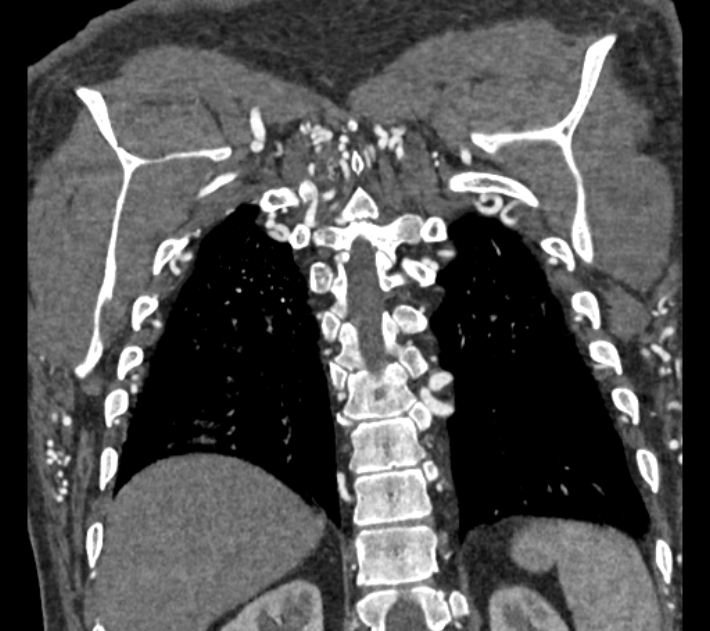 Coarctation of the aorta (Radiopaedia 53752-59822 B 67).jpg