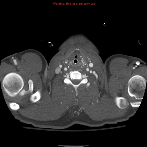 File:Coarctation of the aorta (Radiopaedia 8681-9490 B 1).jpg