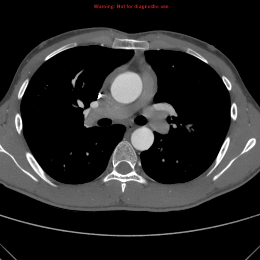 File:Coarctation of the aorta (Radiopaedia 9434-10118 A 82).jpg